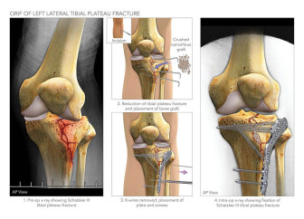 ORIF of Left Lateral Tibial Plateau Fracture
