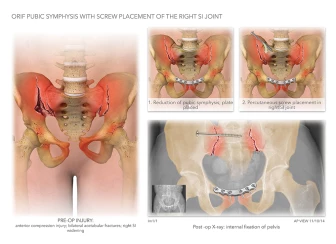 ORIF of Pubic Symphysis with Screw Placement of the SI Joint