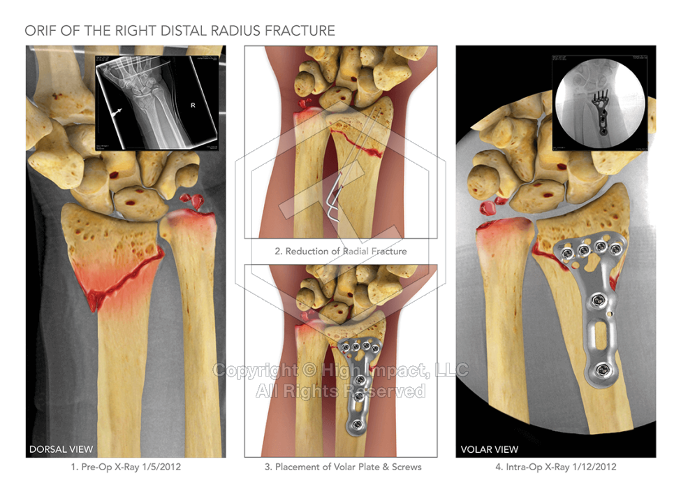 ORIF of Right Distal Radius Fracture
