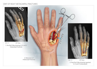 ORIF of Right Metacarpal Fractures