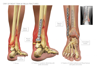 ORIF of Right Tibia and Fibula Fractures