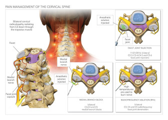 Pain Management of The Cervical Spine