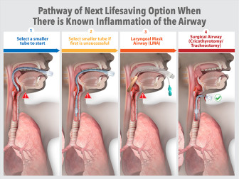 Pathway of Next Lifesaving Option When There is Known Inflammation of the Airway