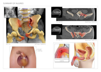 Pelvic Fractures and Surgery