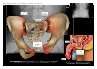 Pelvic Injuries with Complete Urethral Disruption