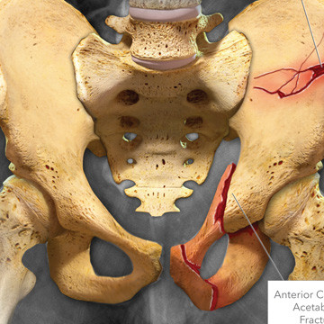 Illustrated X-ray showing severe fractures of the pelvis