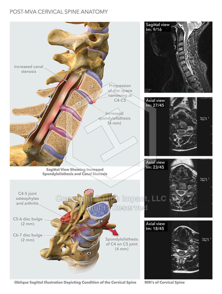 Post-MVA Cervical Spine Anatomy