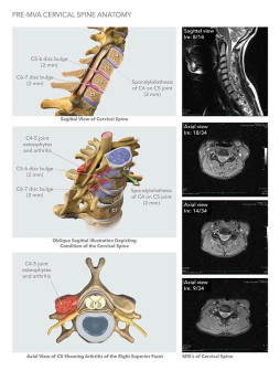 Pre-MVA Cervical Spine Anatomy