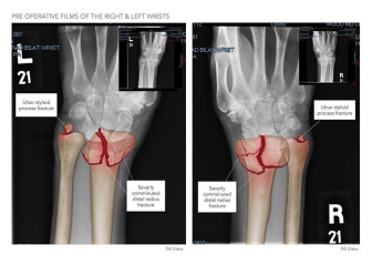 Pre Operative Films of the Right & Left Wrists