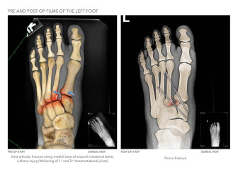 Pre and Post-op Films of the Left foot