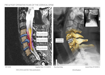 Pre & Post Operative Films of the Cervical Spine