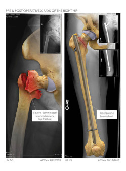 Pre & Post Operative X-Rays of the Right Hip