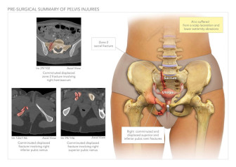 Pre-Surgical Summary of Pelvis Injuries