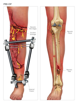 Preoperative Anatomy of the Leg