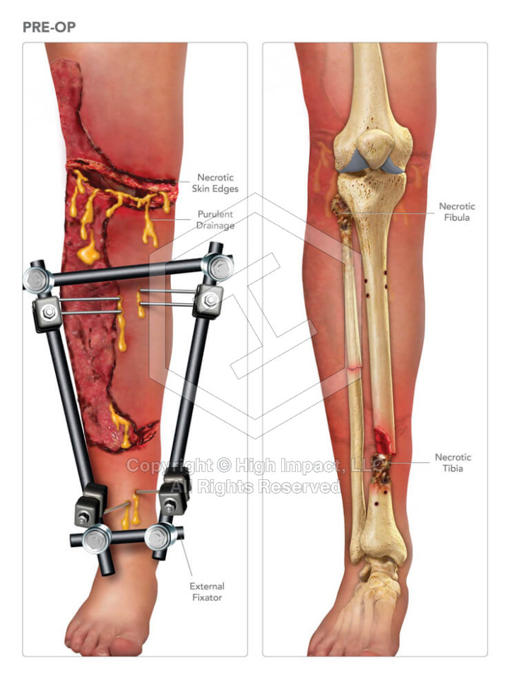 Preoperative Anatomy of the Leg