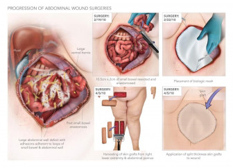 Progression of Abdominal Wound Surgeries