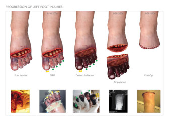 Progression of Foot Injuries