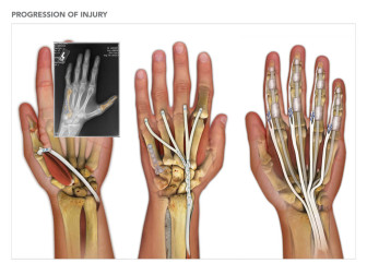 Progression of Hand Injury