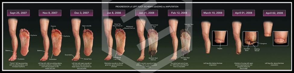 Progression of Left Foot Ischemia