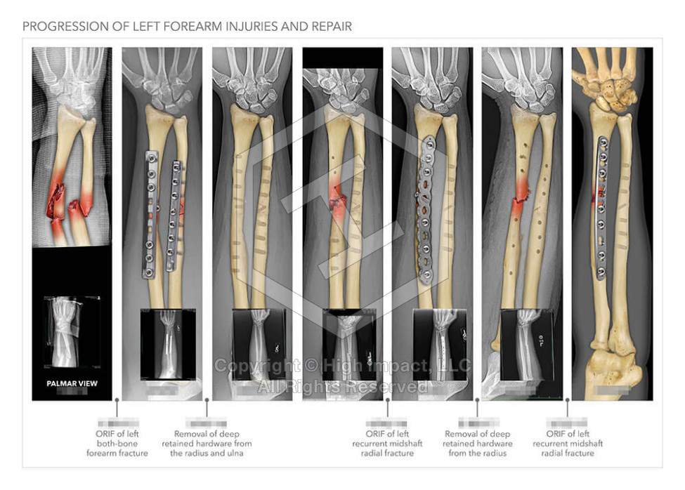 Progression of Left Forearm Injuries and Repair