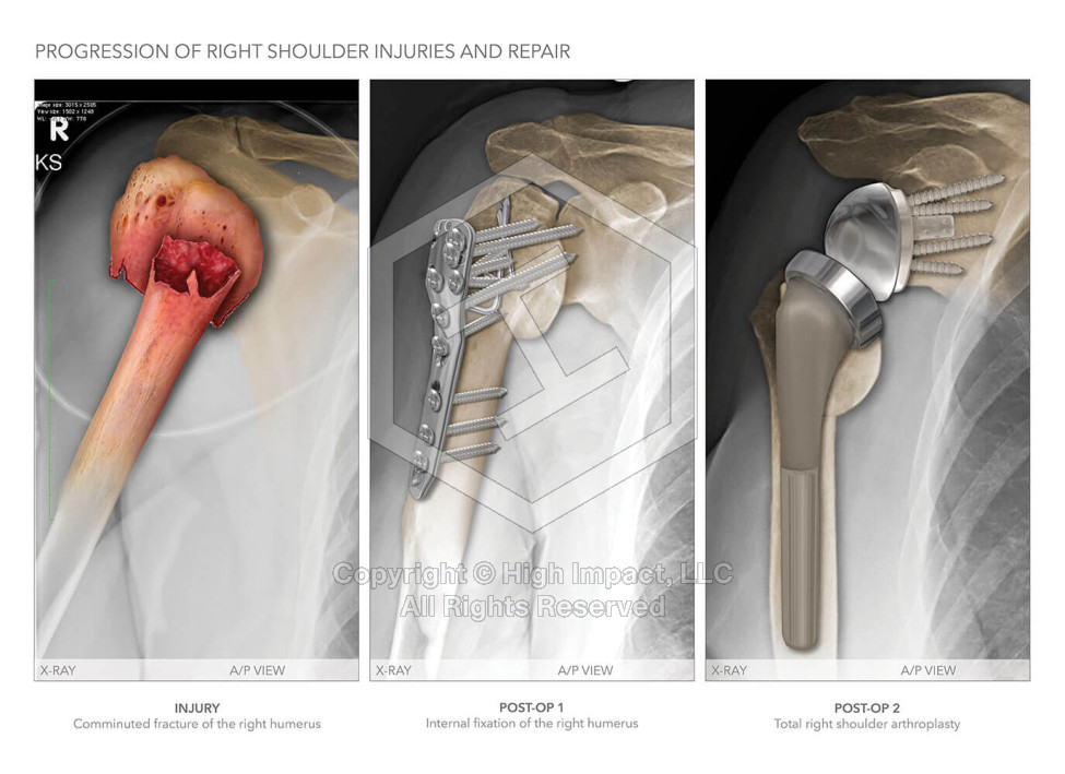 Progression of Right Shoulder Injuries and Repair