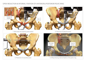 Internal Fixation of Pelvic Ring