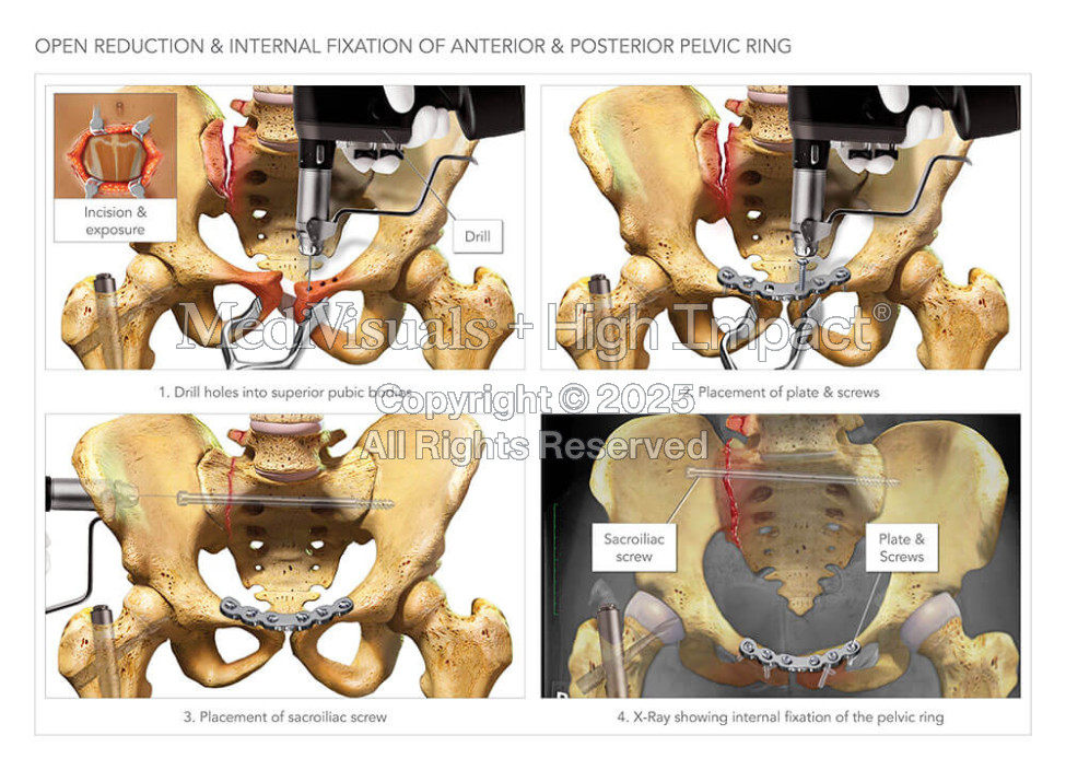 Internal Fixation of Pelvic Ring