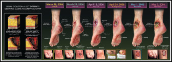 Serial Evolution of Decubitus Ulcers