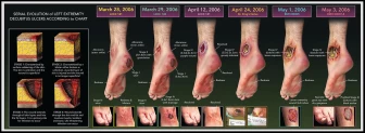 Serial Evolution of Decubitus Ulcers