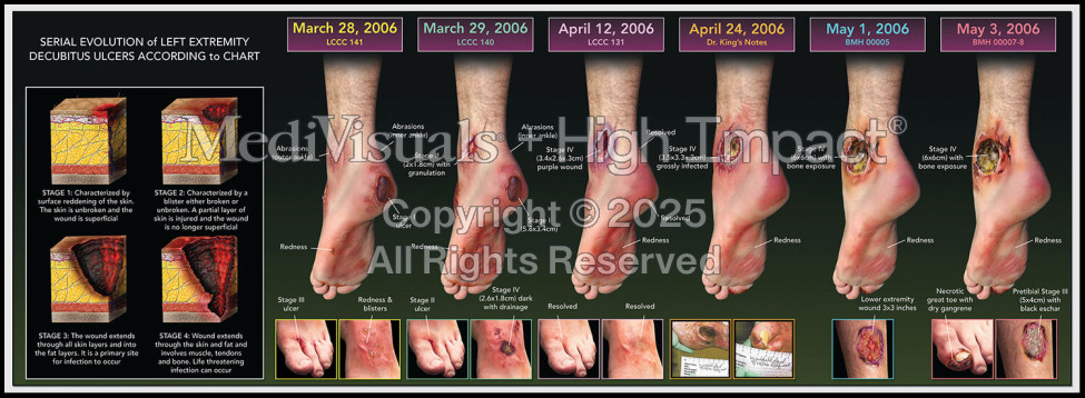 Serial Evolution of Decubitus Ulcers