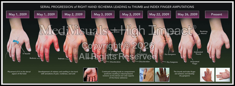 Serial Progression of Right Hand Ischemia