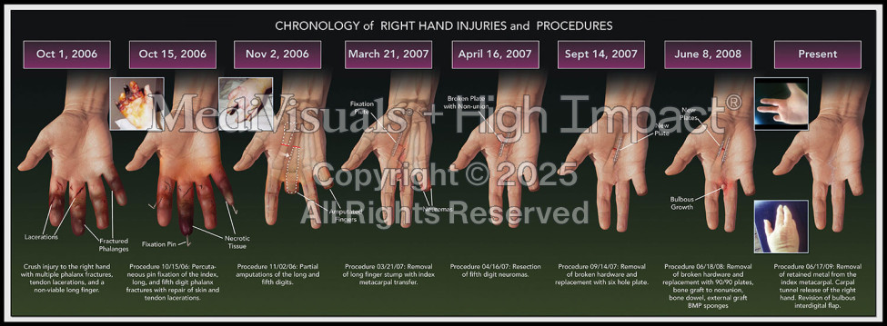 Chronology of Hand Injuries and Procedures