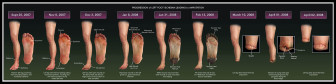 Progression of Left Foot Ischemia