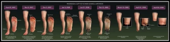 Progression of Left Foot Ischemia