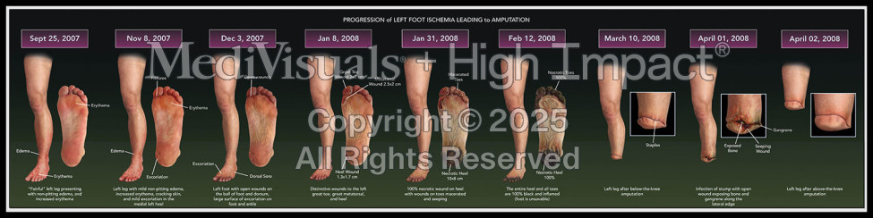 Progression of Left Foot Ischemia
