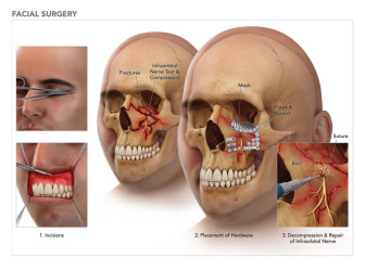 Facial Surgery