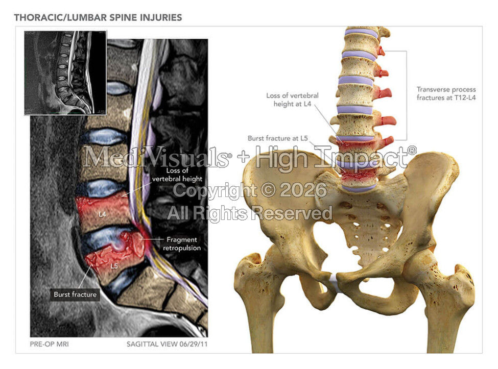 Thoracic/Lumbar Spine Injuries