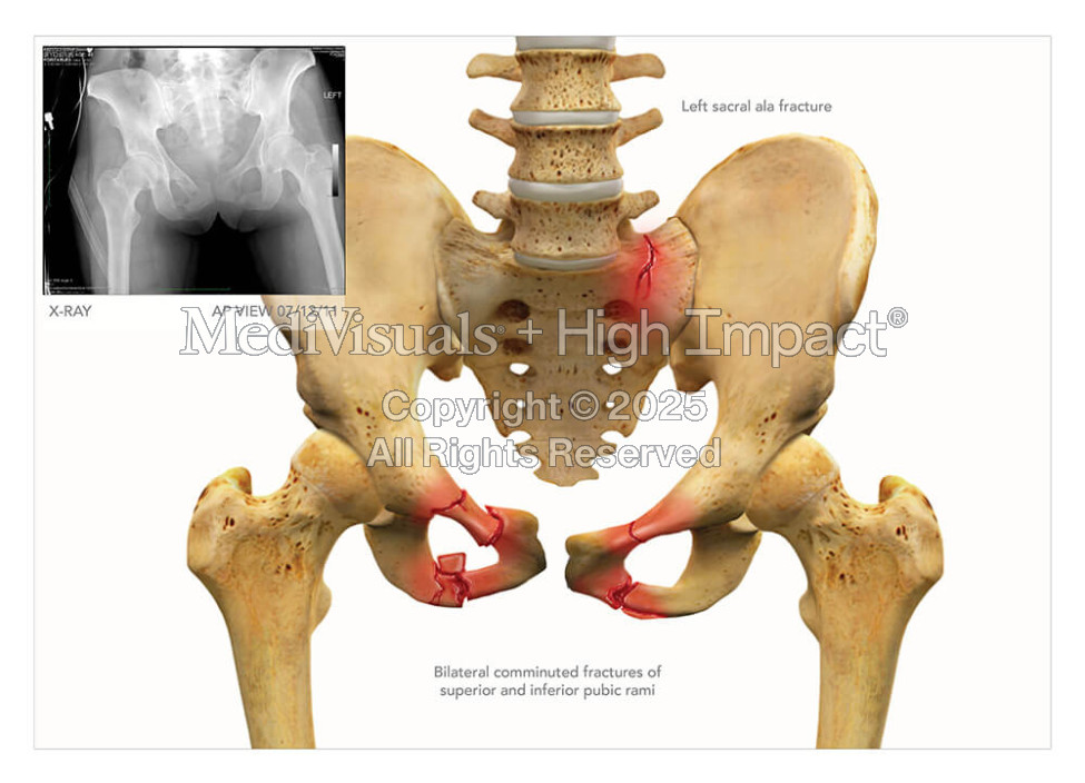 Pelvic Fractures