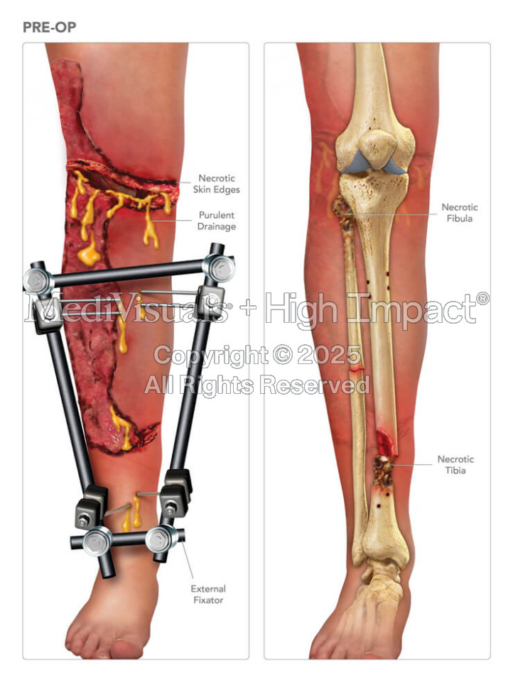 Preoperative Anatomy of the Leg