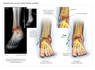 Chronology of Ankle Injury & Repair