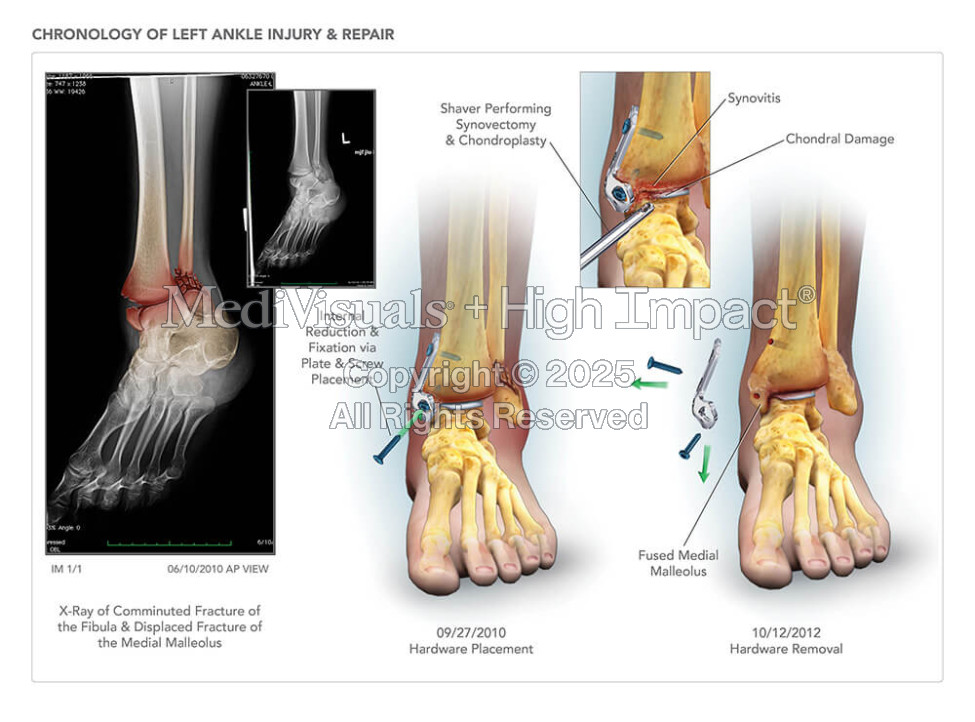 Chronology of Ankle Injury & Repair