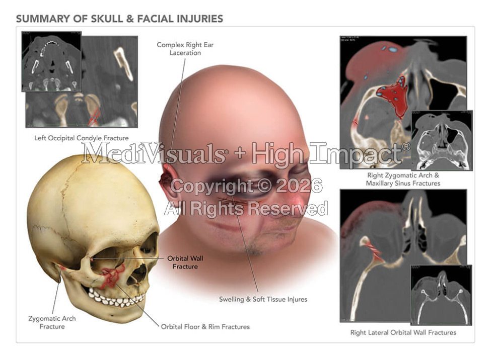 Summary of Skull & Facial Injuries