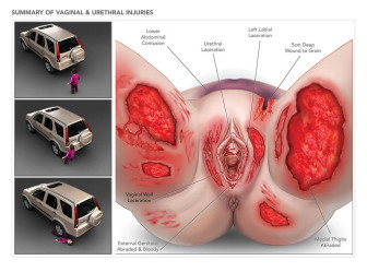 Summary of Vaginal & Urethral Injuries