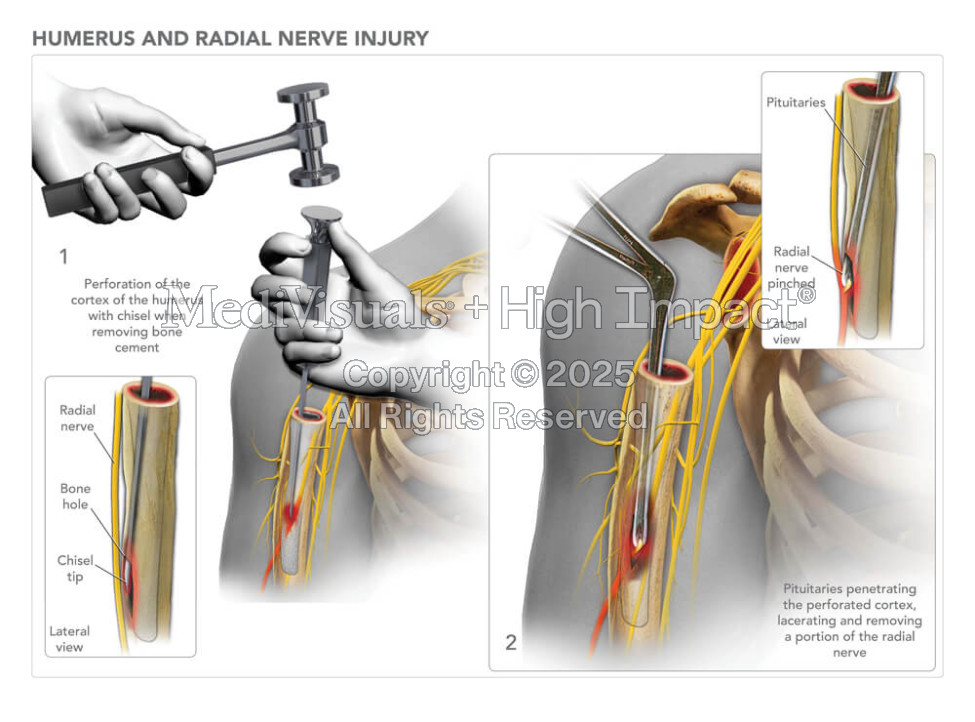Humerus and Radial Nerve Injury