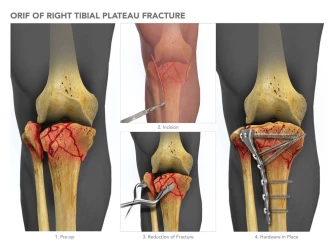 ORIF of Left Lateral Tibial Plateau Fracture | MediVisuals + High Impact