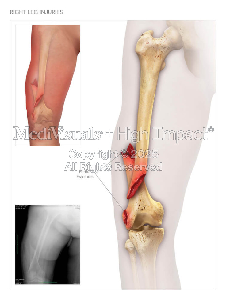 Right Leg Injuries