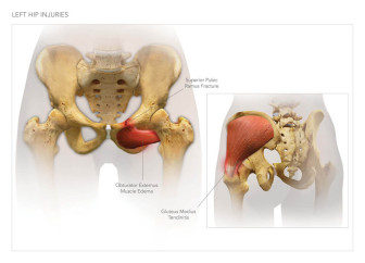 Left Hip Injuries