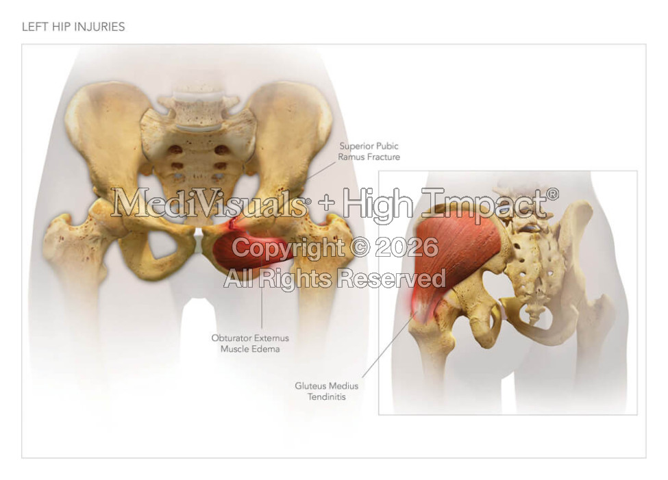 Left Hip Injuries