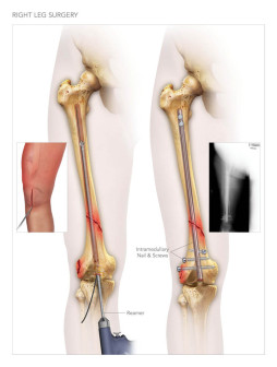 Right Leg Surgery