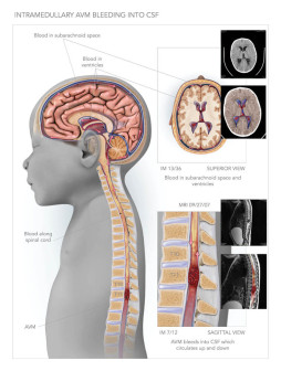 Intramedullary AVM Bleeding into CSF
